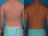 Liposuction; flanks