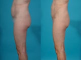 Liposuction; abdomen