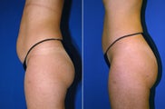 Liposuction
