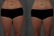 CoolSculpting of the Inner Thighs
