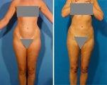 Liposuction