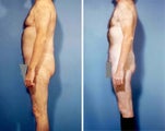 Liposuction