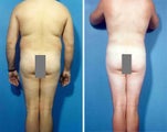 Liposuction
