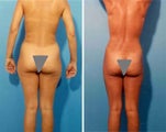 Liposuction
