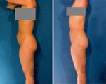 Liposuction