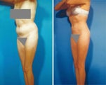 Liposuction