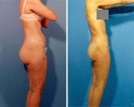 Liposuction