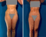 Liposuction