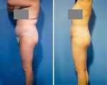 Liposuction