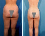 Liposuction