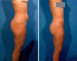 Liposuction