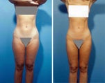 Liposuction