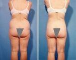 Liposuction