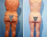 Liposuction