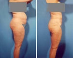 Liposuction