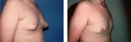 Gynecomastia