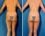 Liposuction
