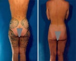 Liposuction