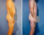 Liposuction