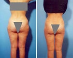 Liposuction
