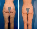 Liposuction