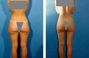 Liposuction