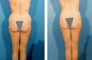 Liposuction