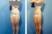 Liposuction
