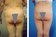 Liposuction
