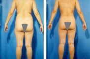 Liposuction