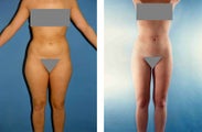 Liposuction