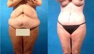 Lower Body Lift with Liposuction and Fat Transfer