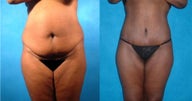 Lower Body Lift with Liposuction and Fat Injections