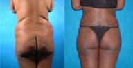 Lower Body Lift with Liposuction and Fat Injections