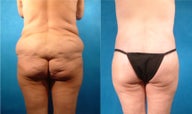 Lower Body Lift with Fat Transfer and Liposuction