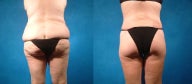 Lower Body Lift