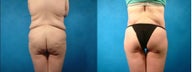 Lower Body Lift