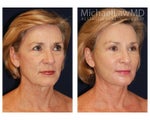 Lower Face and Neck Lift
