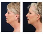 Lower Face and Neck Lift