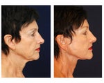 Lower Face and Neck Lift