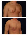 Gynecomastia (Male Breast Reduction)