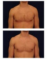 Gynecomastia (Male Breast Reduction)