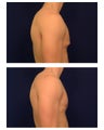 Gynecomastia (Male Breast Reduction)