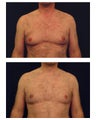 Gynecomastia (Male Breast Reduction)