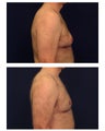 Gynecomastia (Male Breast Reduction)