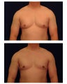 Gynecomastia (Male Breast Reduction)
