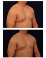 Gynecomastia (Male Breast Reduction)