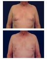 Gynecomastia (Male Breast Reduction)