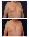 Gynecomastia (Male Breast Reduction)
