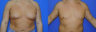 Male breast reduction (gynecomastia)